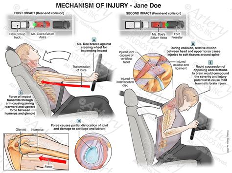 The intrusion on the B post obstructs the movement or twists the back of the seat itself, often towards the intrusion. . Which of the following occurs during the third impact of a motor vehicle crash